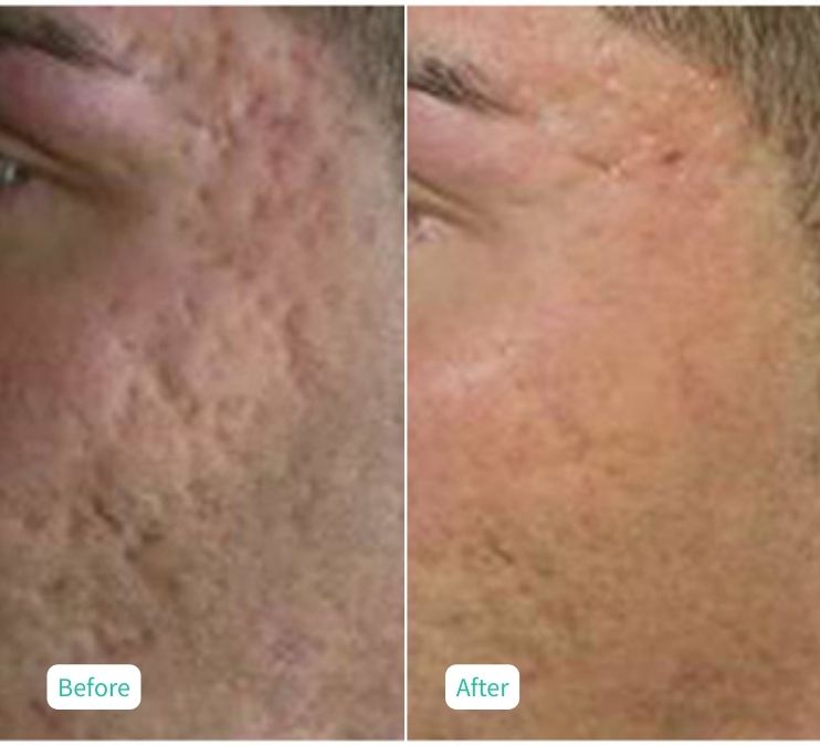 Collagen Skin Rejuvenation - Case 10