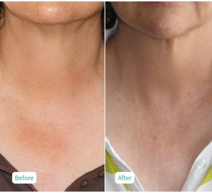 Collagen Skin Rejuvenation - Case 11