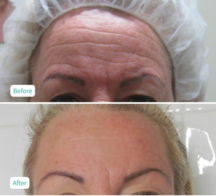 Collagen Skin Rejuvenation - Case 12