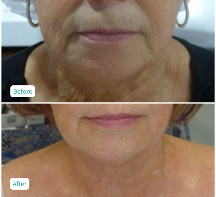 Collagen Skin Rejuvenation - Case 13