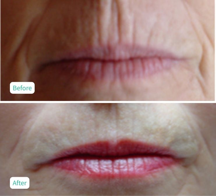 Collagen Skin Rejuvenation - Case 14