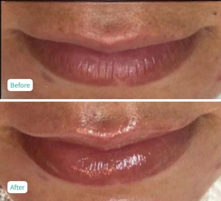 CSR Nanofusion Facial - Case 11