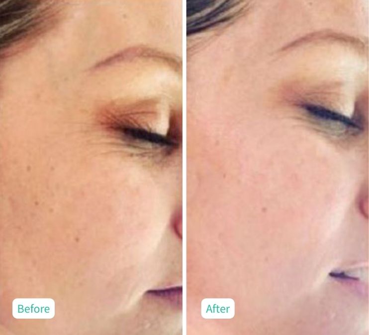 CSR Nanofusion Facial - Case 12