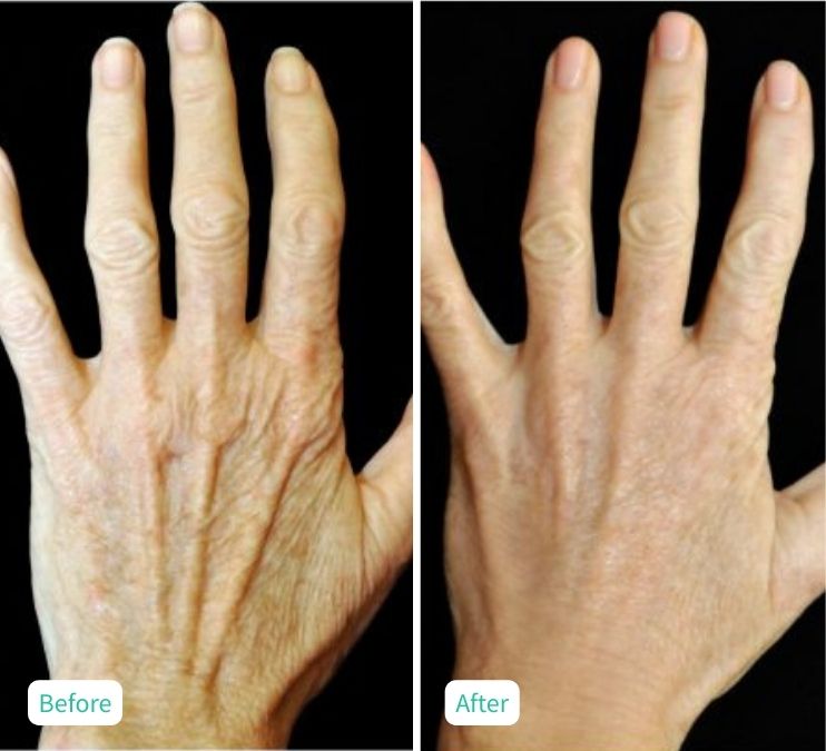 Hands(1)