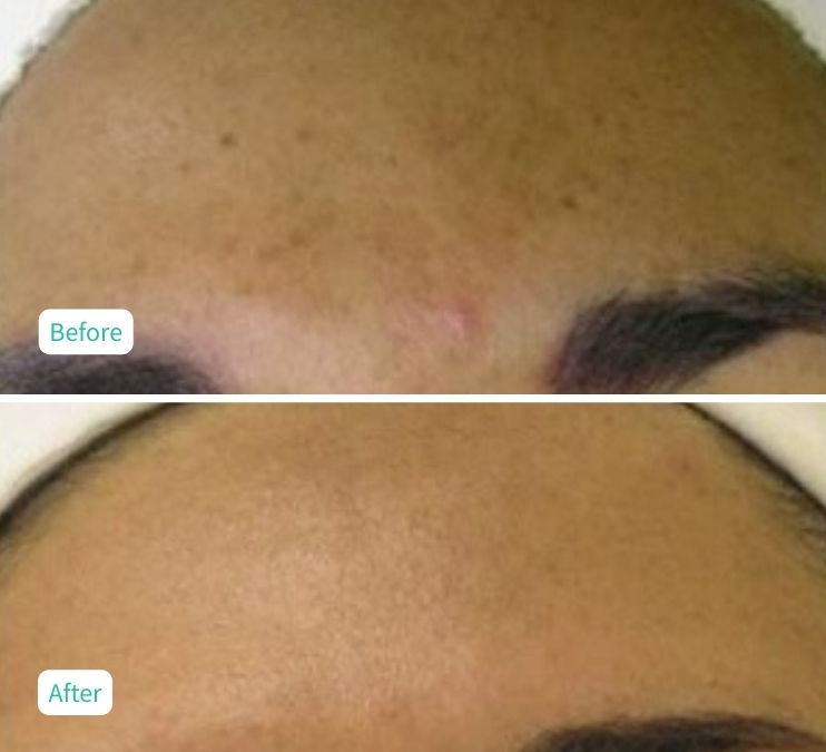 Hydroglow Facial - Case 2(1)