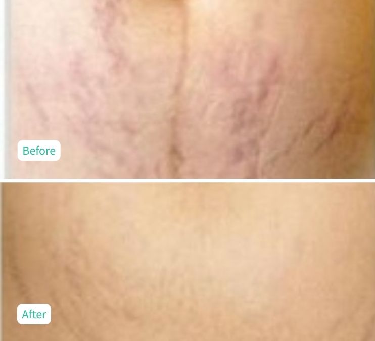 Hydroglow Facial - Case 3