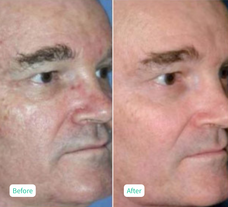 Microlaser Peel - Case 4