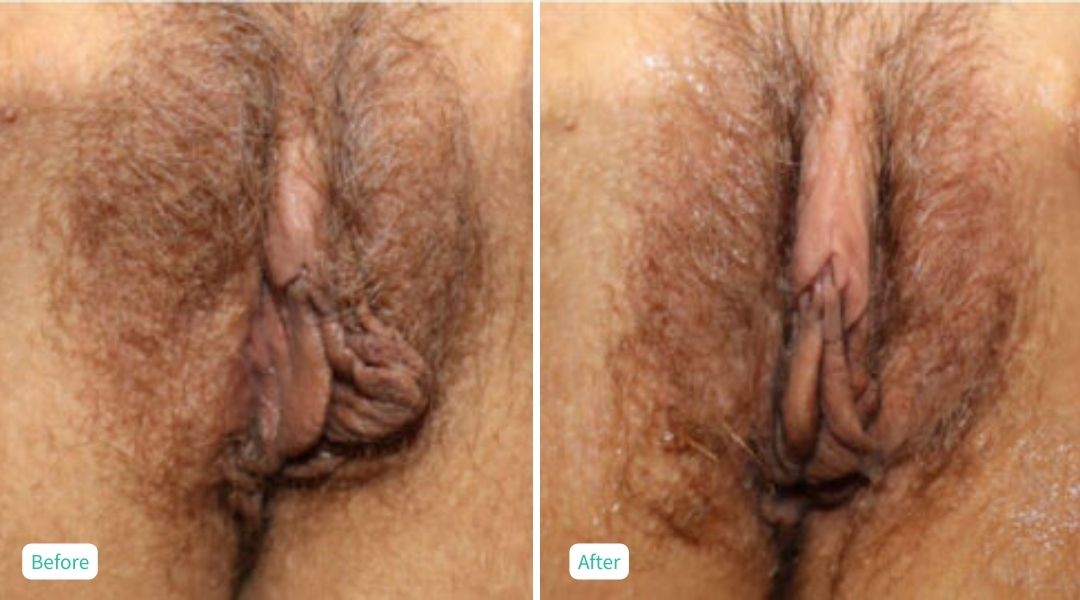 Nonsurgical Vaginal Rejuvenation - Case 1