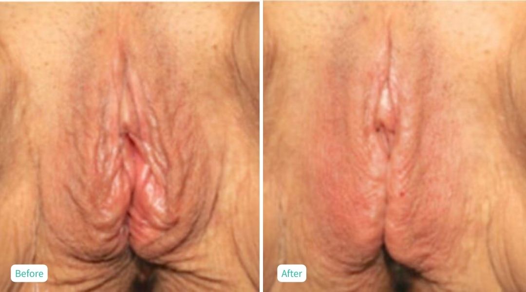 Nonsurgical Vaginal Rejuvenation - Case 11