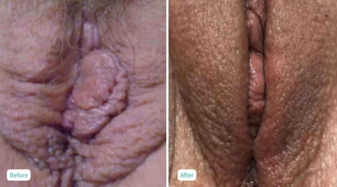 Nonsurgical Vaginal Rejuvenation - Case 12