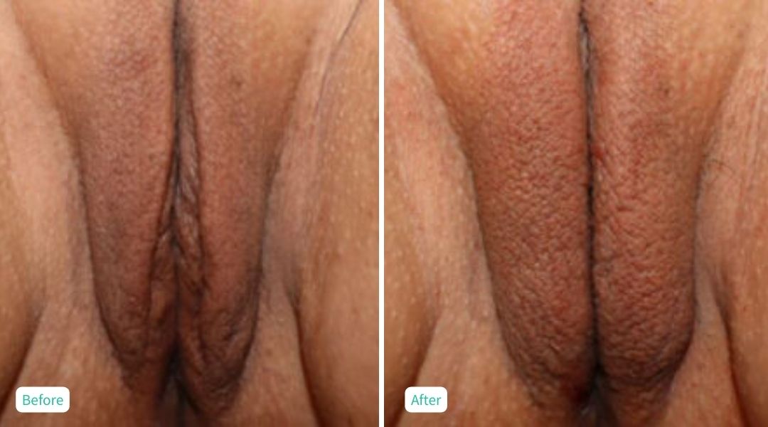 Nonsurgical Vaginal Rejuvenation - Case 2