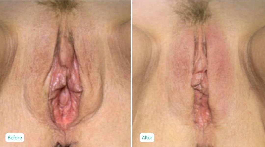 Nonsurgical Vaginal Rejuvenation - Case 3