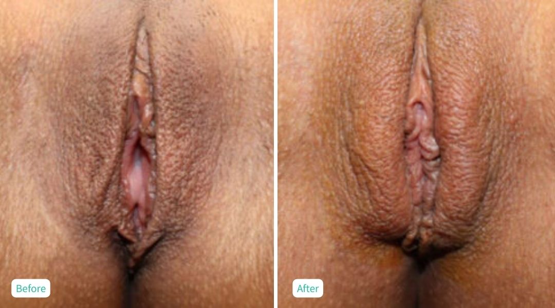 Nonsurgical Vaginal Rejuvenation - Case 4