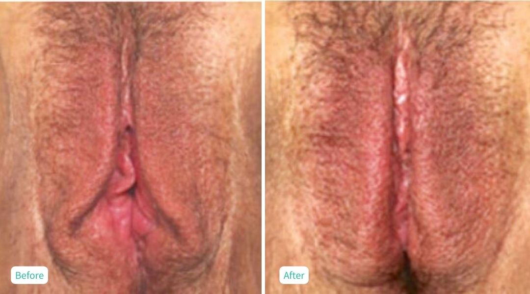 Nonsurgical Vaginal Rejuvenation - Case 5