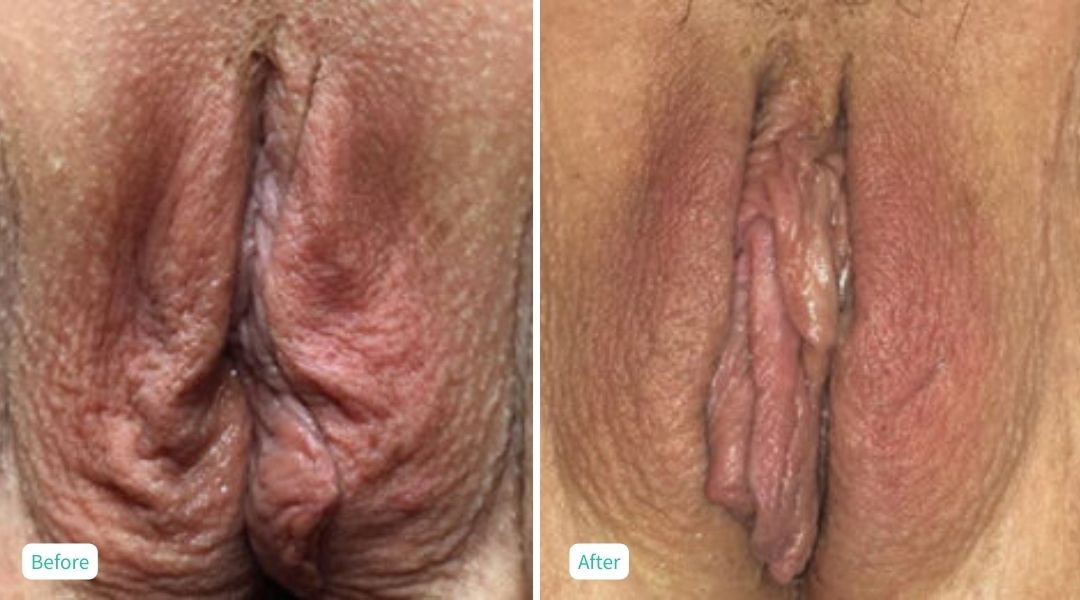 Nonsurgical Vaginal Rejuvenation - Case 6
