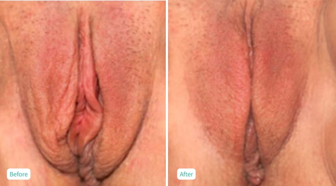 Nonsurgical Vaginal Rejuvenation - Case 7