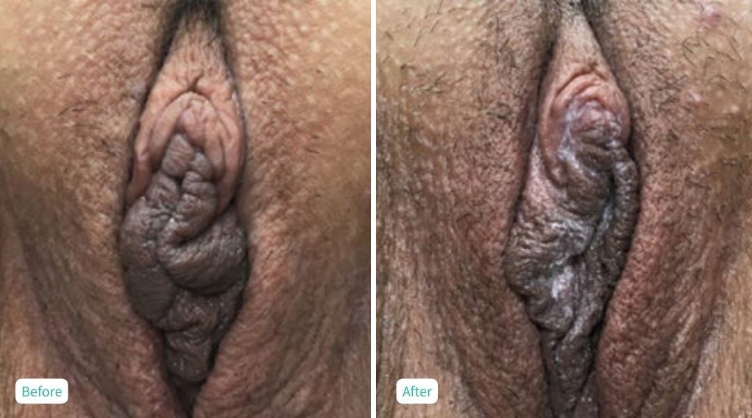 Nonsurgical Vaginal Rejuvenation - Case 8