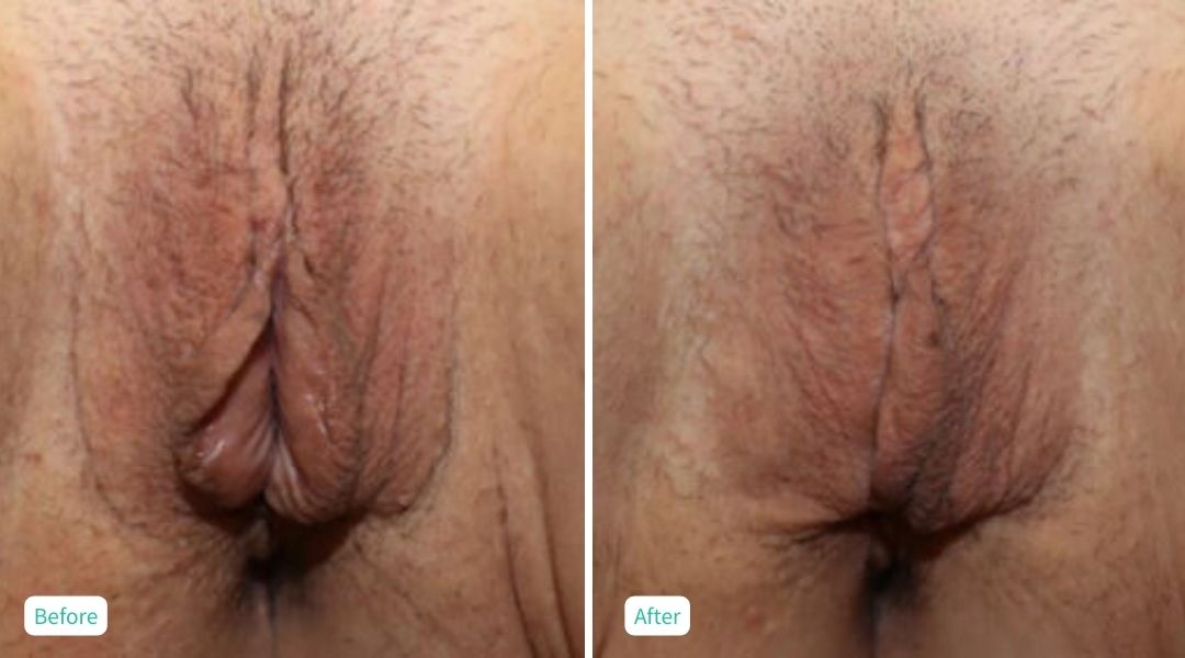 Nonsurgical Vaginal Rejuvenation - Case 9