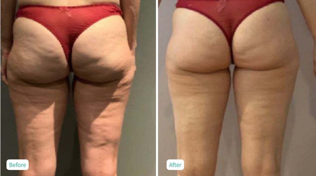Cellulite Treatment 12 sessions - Case 1