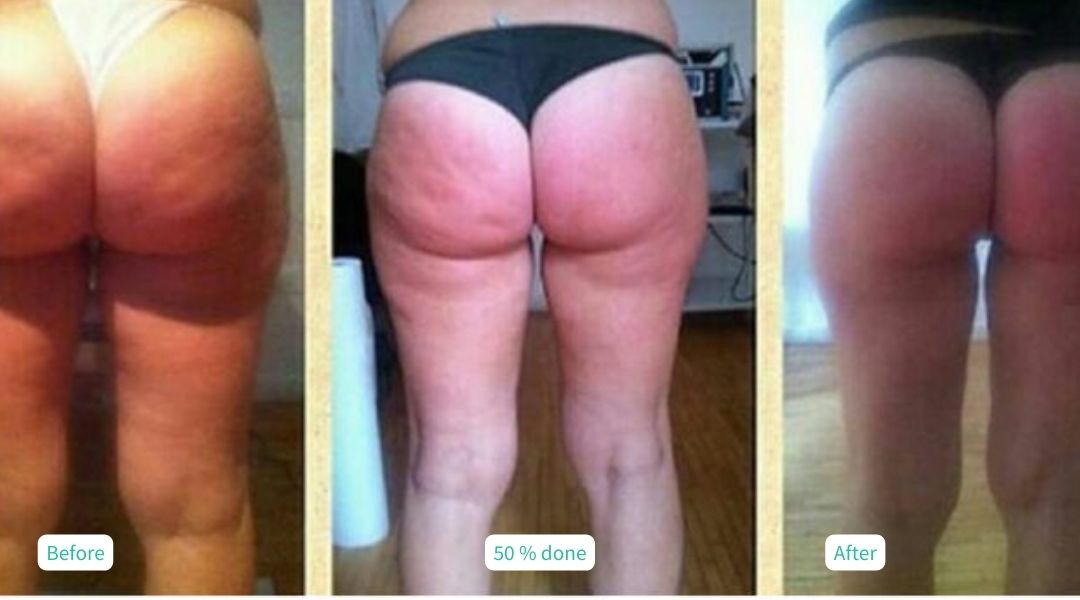 Cellulite Treatment 12 sessions - Case 11