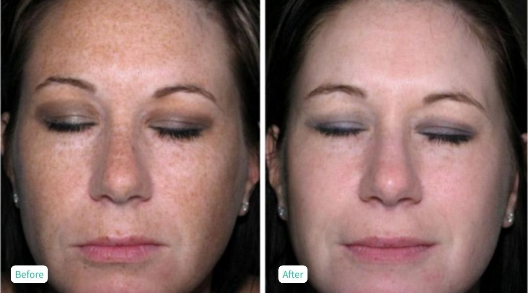 IPL Photofacial - Case 1