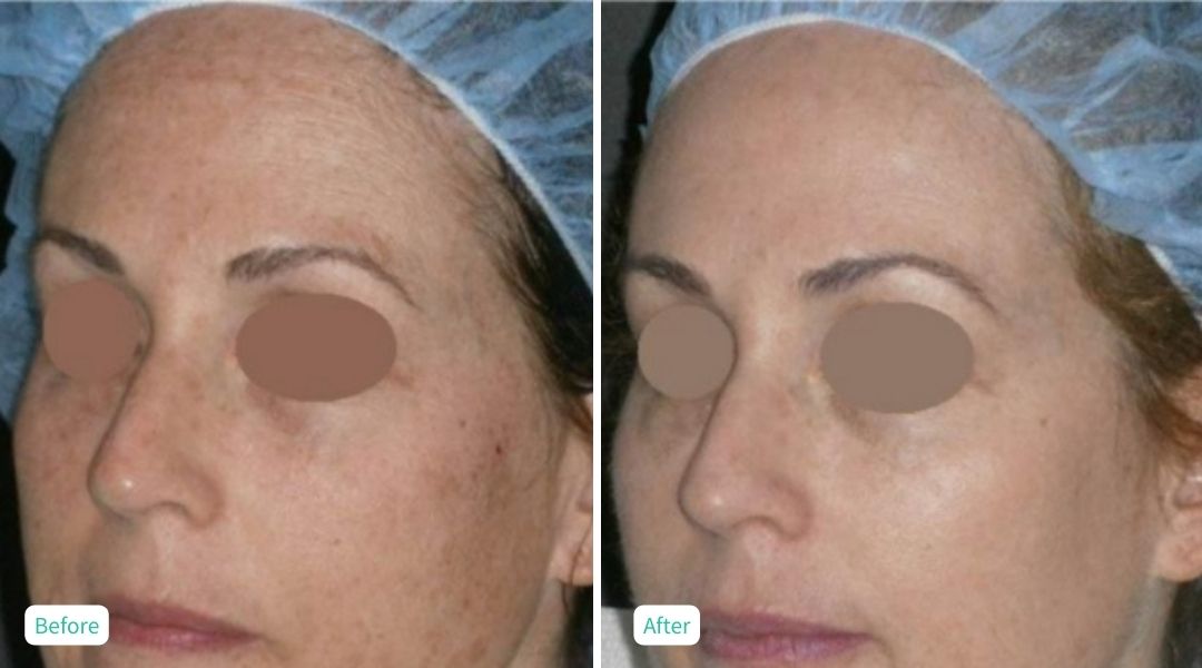 IPL Photofacial - Case 2