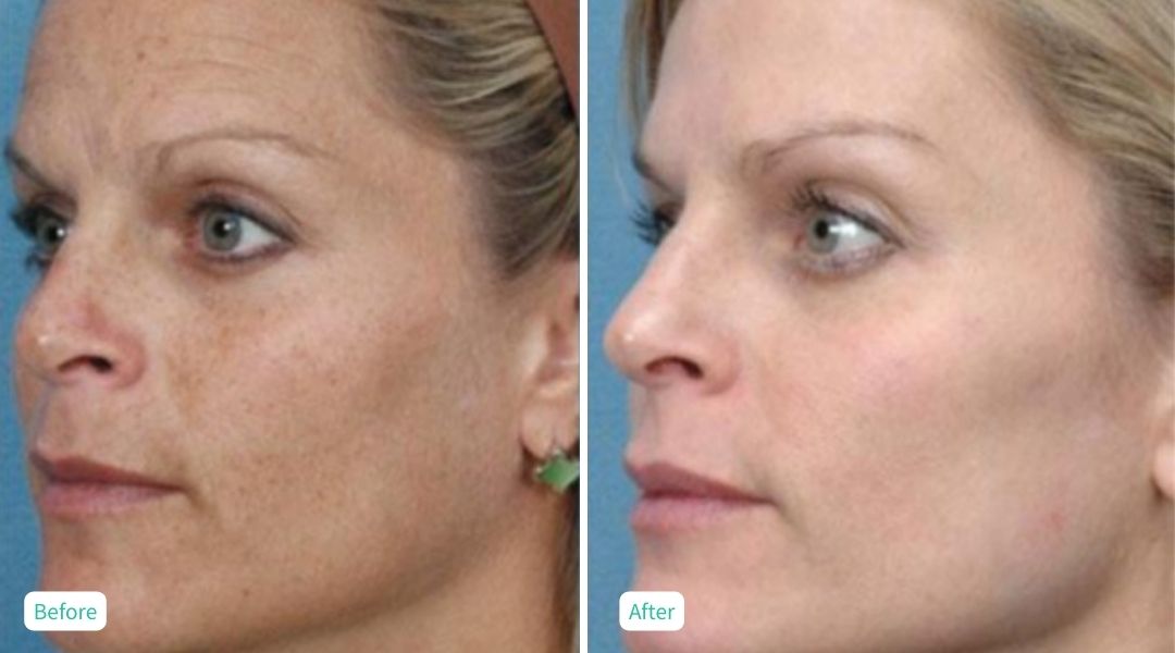 IPL Photofacial - Case 3