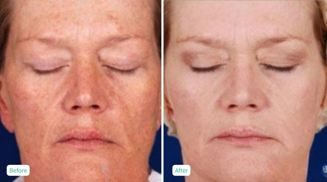 IPL Photofacial - Case 4