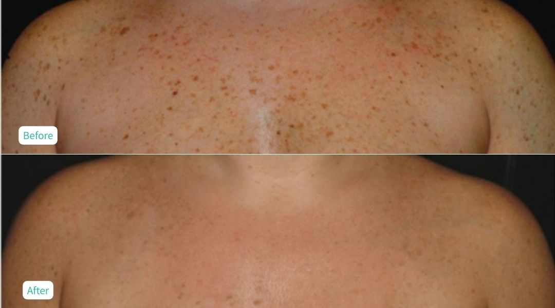 IPL Photofacial - Case 6
