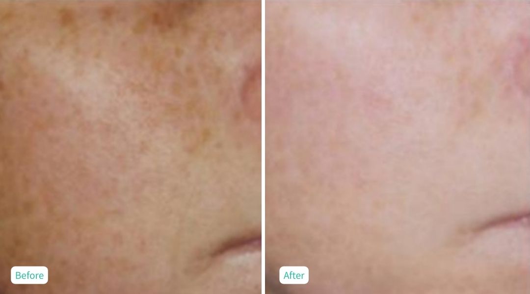IPL Photofacial - Case 5