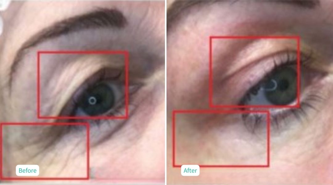 Nitrogen Plasma Skin Tightening 3 weeks after- Case 5