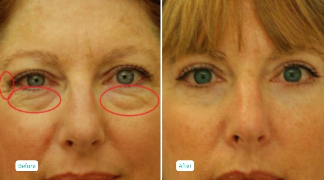 Nitrogen Plasma Skin Tightening - Case 1