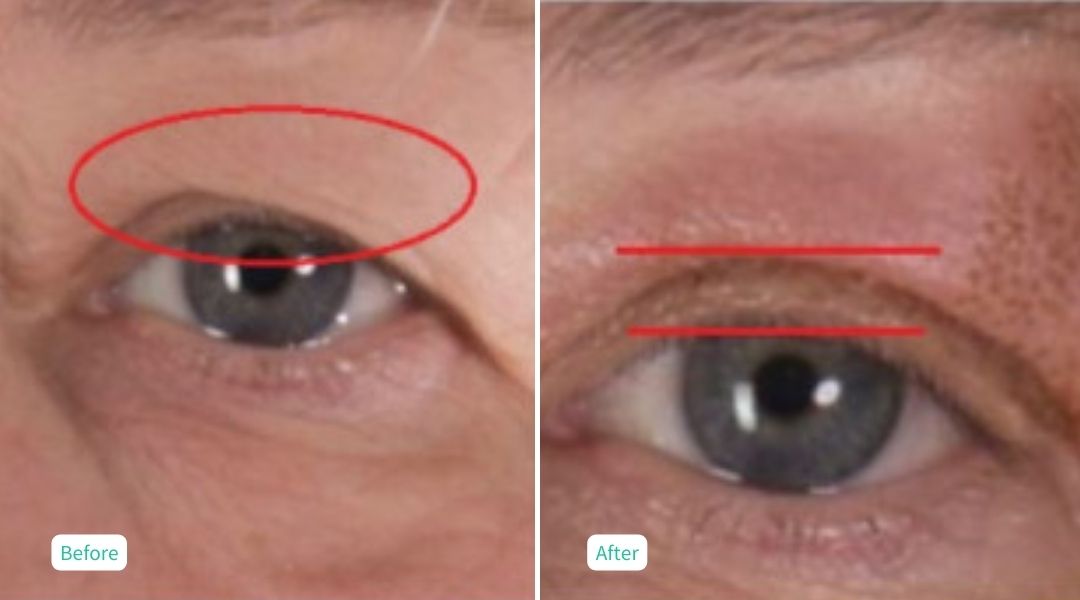 Nitrogen Plasma Skin Tightening- Case 10
