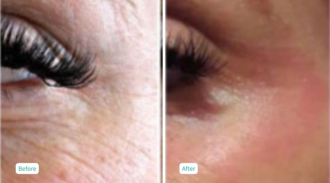 Nitrogen Plasma Skin Tightening- Case 11