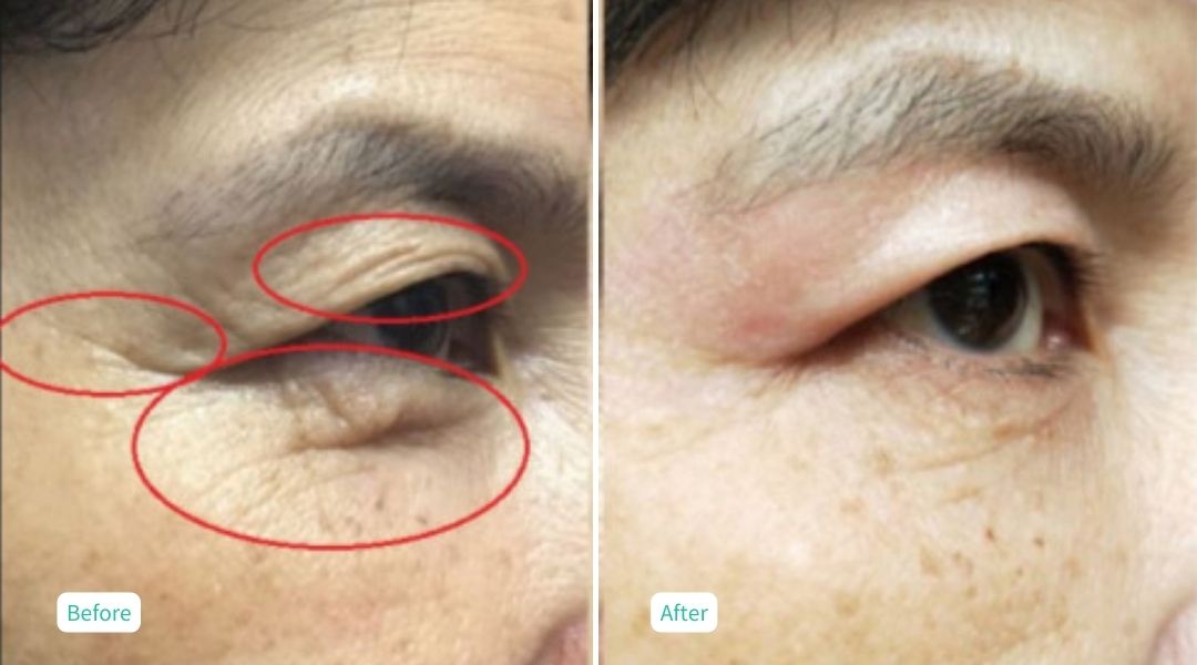 Nitrogen Plasma Skin Tightening - Case 2