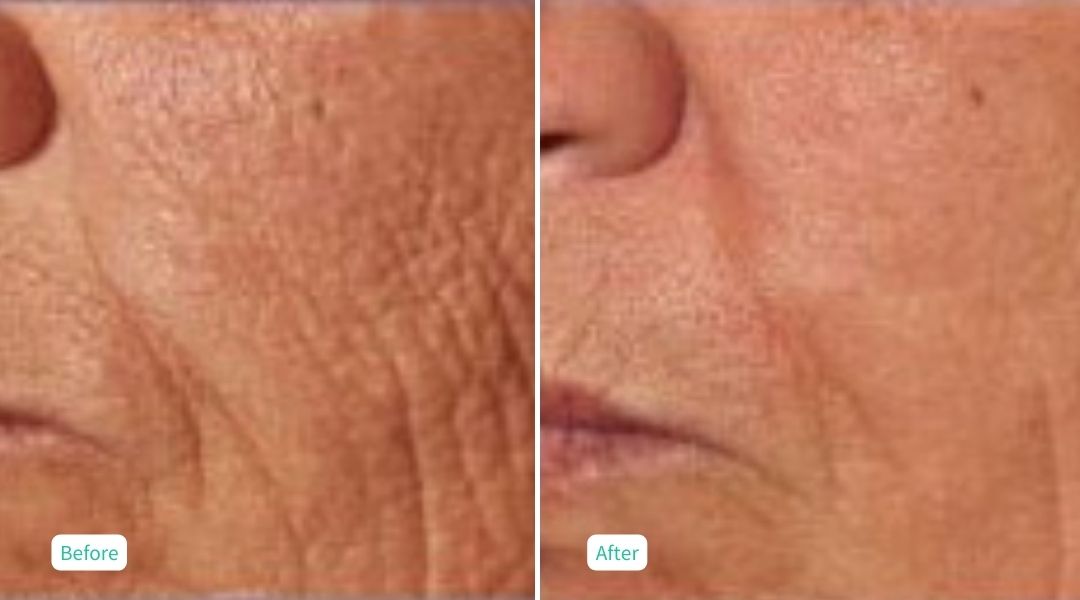 Nitrogen Plasma Skin Tightening- Case 6