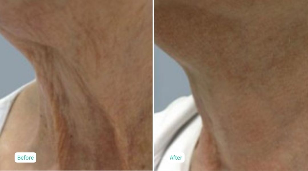 Nitrogen Plasma Skin Tightening- Case 7