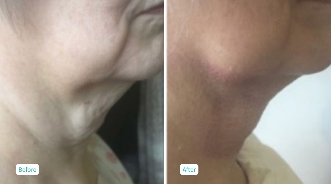 Nitrogen Plasma Skin Tightening- Case 8