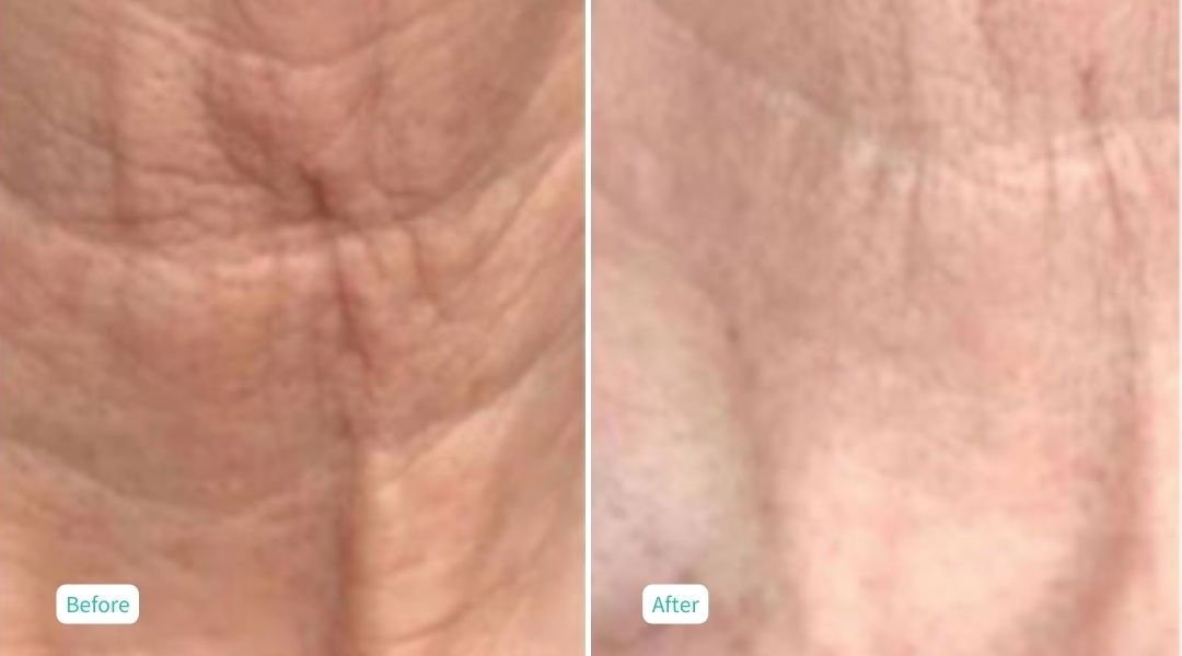 Nitrogen Plasma Skin Tightening- Case 9