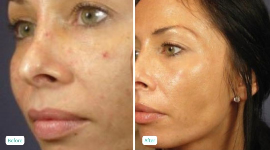 Perfection Peel - Case 2