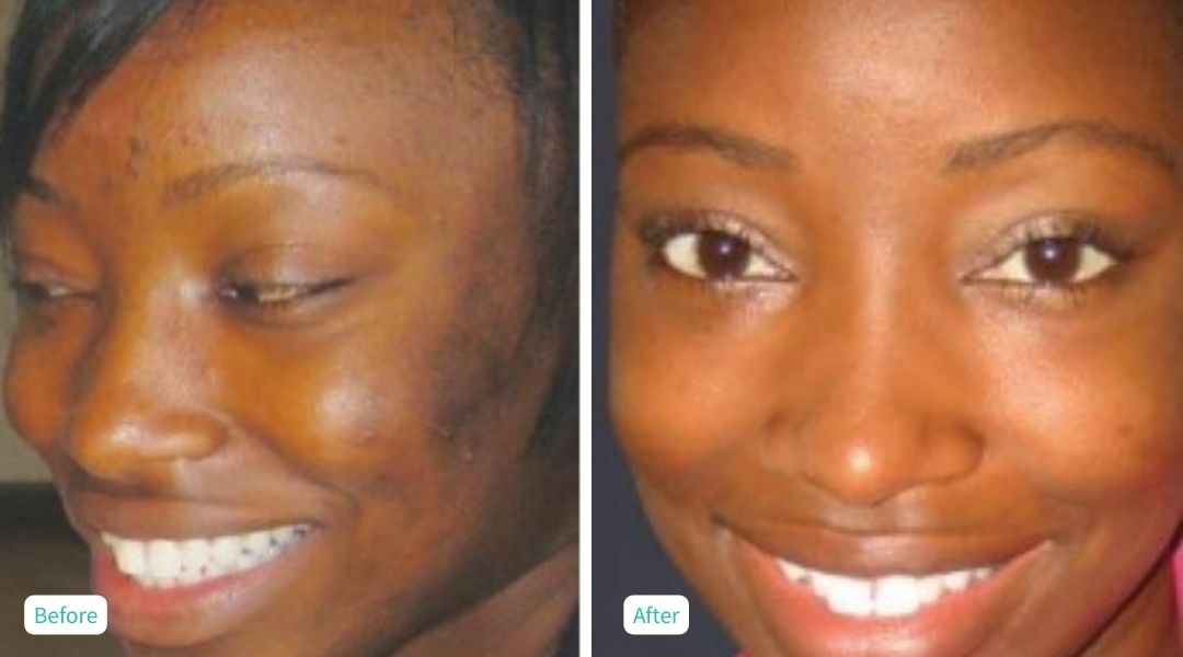 Perfection Peel - Case 3
