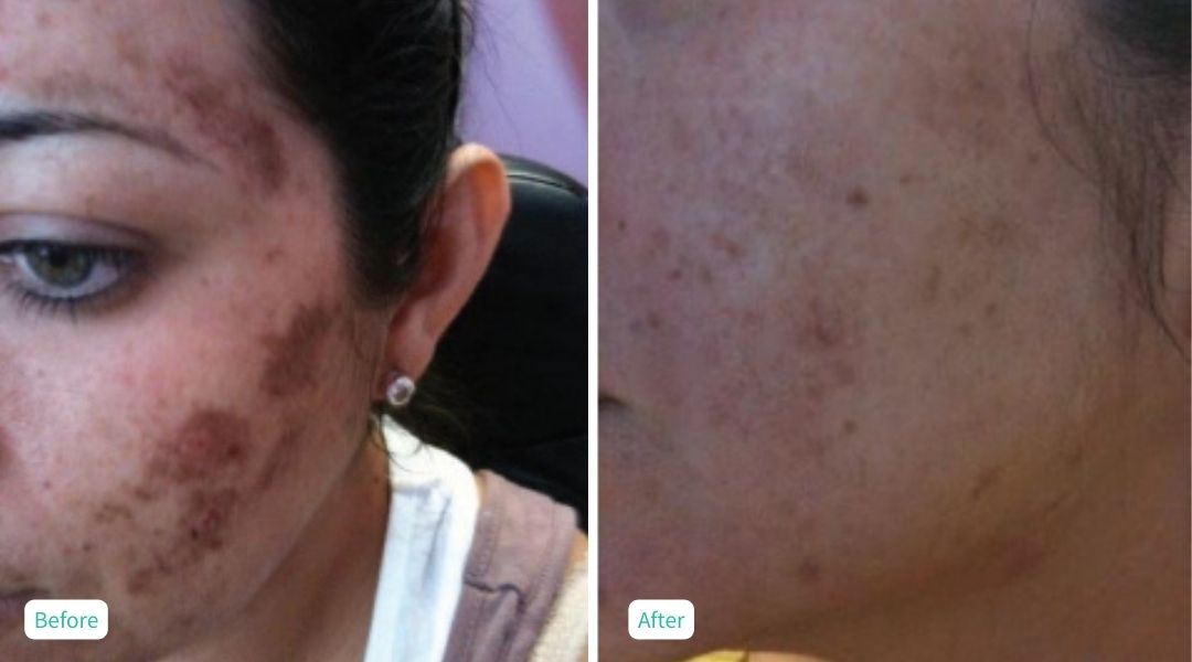 Perfection Peel - Case 4