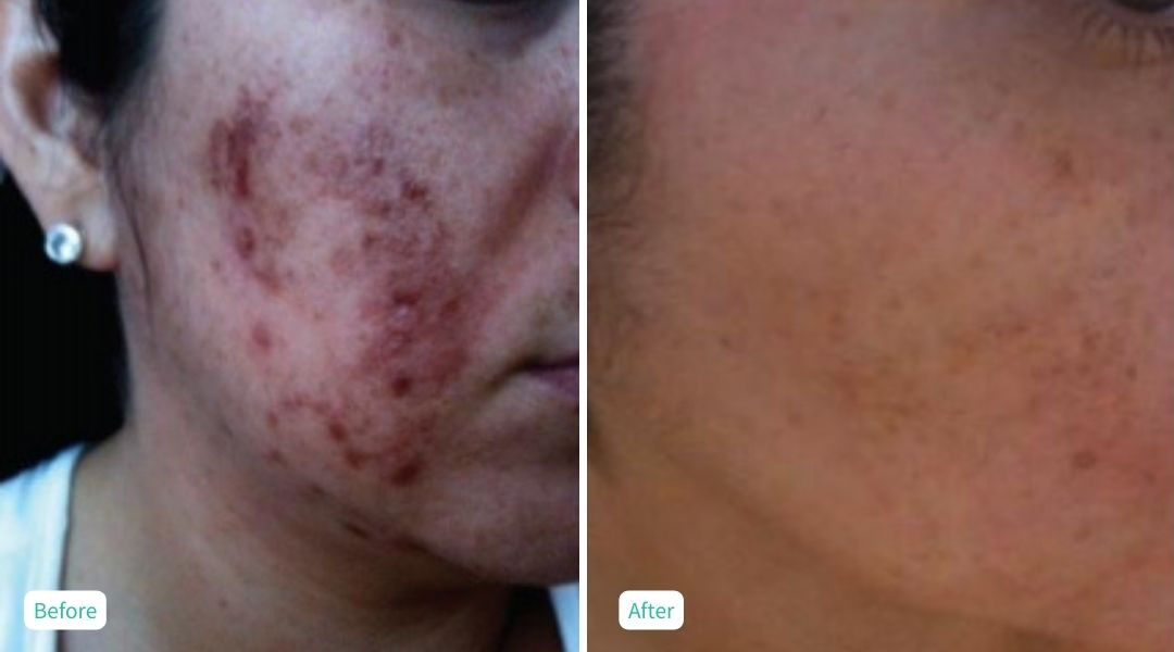 Perfection Peel - Case 5