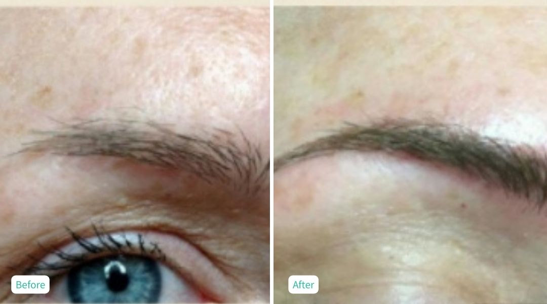 Permanent Make UP - Case 1