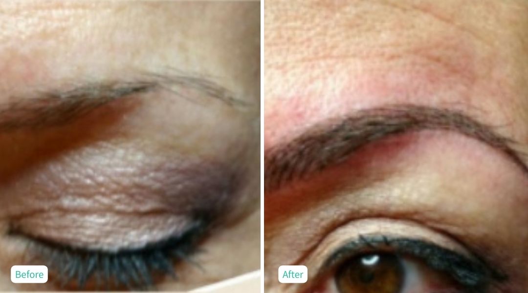 Permanent Make UP - Case 5
