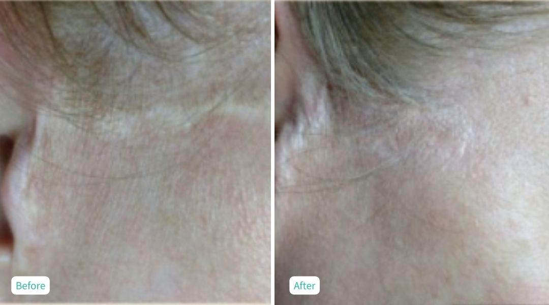 Permanent Make UP - Case 8