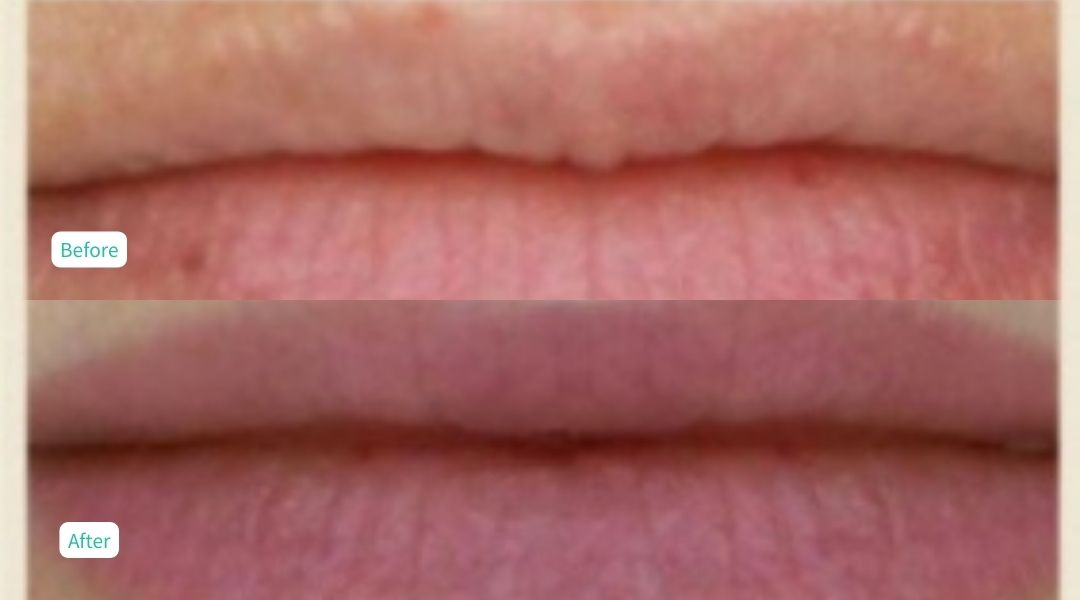 Permanent Make UP - Case 9