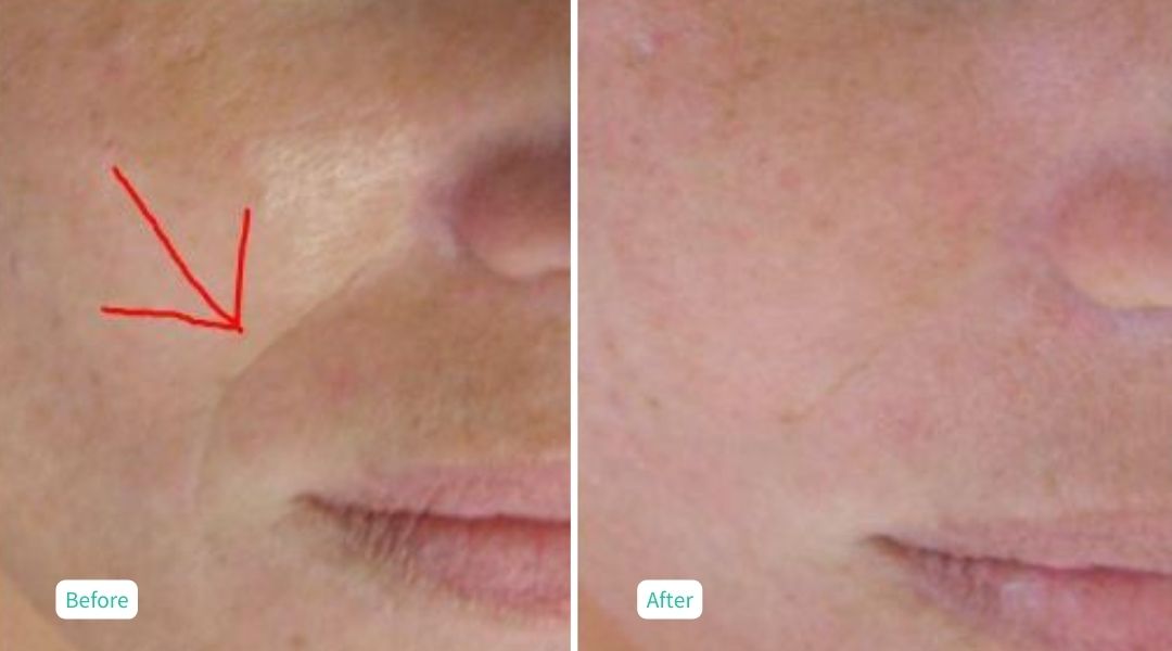 Ultrafusion Skin Rejuvenation - Case 2