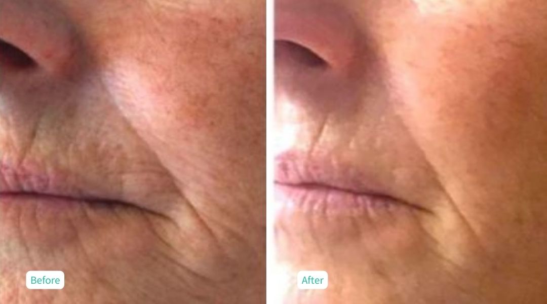 Ultrafusion Skin Rejuvenation - Case 5