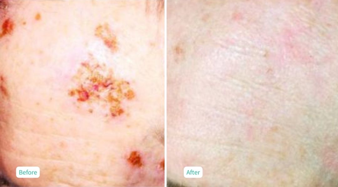 Ultrafusion Skin Rejuvenation - Case 6
